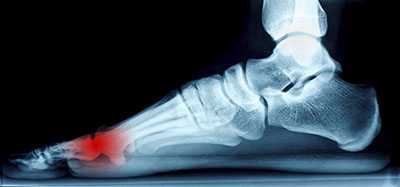 neuromas treatment in the Ottawa County, MI: Grand Haven, Grand Haven Charter Township, Spring Lake Township, Park Township, Holland, Holland Charter Township, Georgetown Township, Zeeland Charter Township, Muskegon County, MI: Muskegon, Norton Shores, Muskegon Township, Fruitport Charter Township, Egelston Township, Roosevelt Park, North Muskegon areas