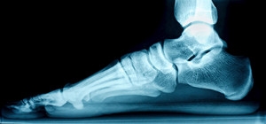 How Common Are Flat Feet?