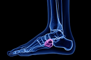 Who Is Prone to Getting Cuboid Syndrome?