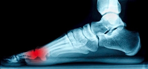 Understanding Sesamoiditis