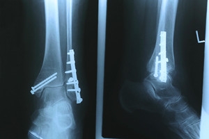 How Stress Fractures Develop and Differ From Breaks