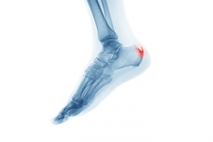 Possible Relief Methods for Heel Spurs