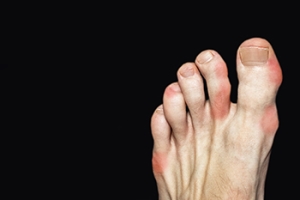 What Is Gout?