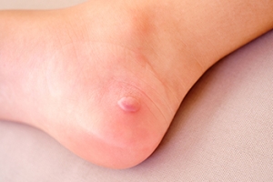 Preventing Blisters While Playing Tennis